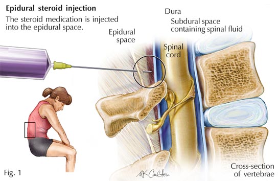 Epidural Steroid Injection for Back Pain: How Long Does It Last