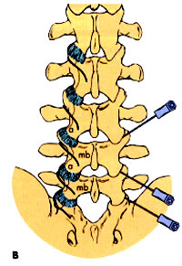 Cervical epidural steroid injection indications
