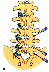 Epidural steroid injection indications