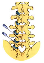 Lumbar epidural steroid injection painful