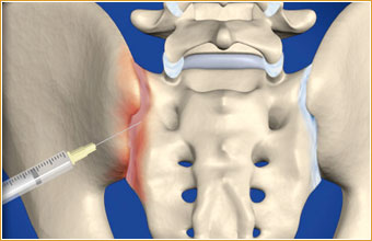 Epidural steroid injections for low back pain and sciatica