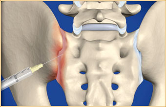 Steroid injection in hip area